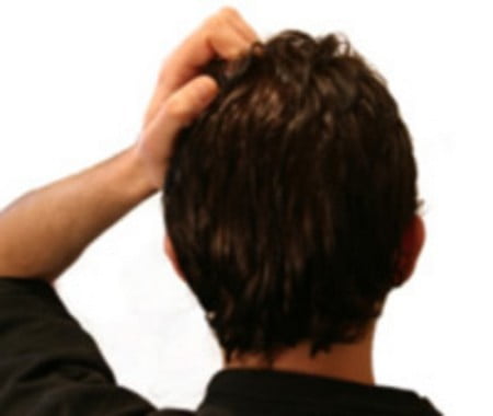 Haaruitval gaat vaak samen met jeuk